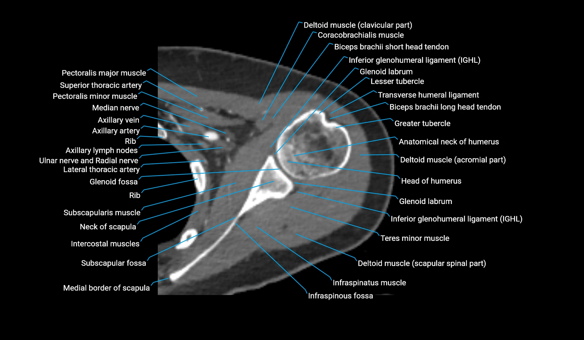CT upper arm axial  cross sectional anatomy labelled radiology image -00100.webp